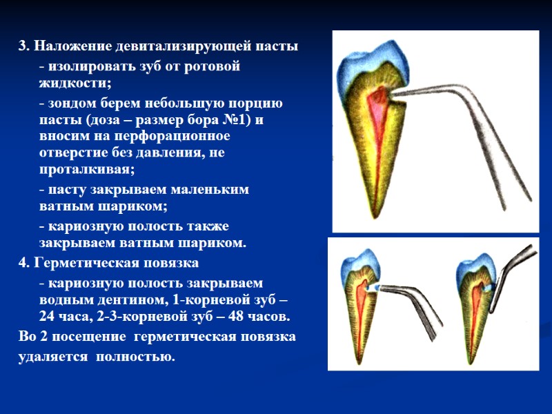 3. Наложение девитализирующей пасты  - изолировать зуб от ротовой жидкости;  - зондом